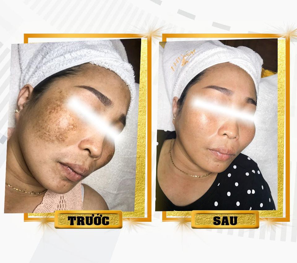 Điều trị nám da mặt tại Thu Minh Beauty - hiệu quả 99%